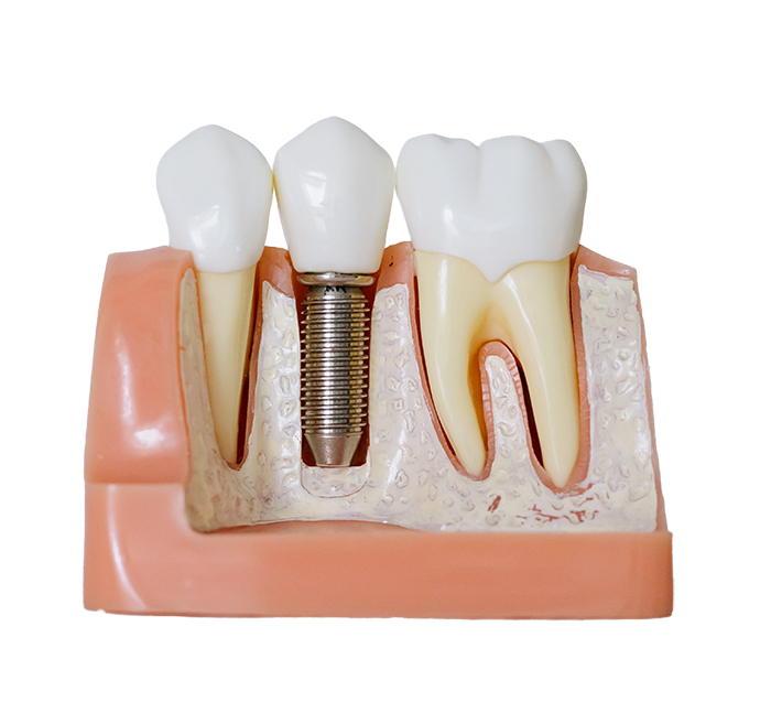 Tratamiento Endodoncia en Monterrey | Regiodental