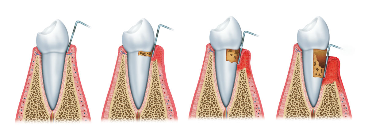 Periodontitis, problema de inflamación de encías