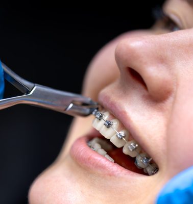 Dental procedure for installing braces close up. Dentistry. Braces on the teeth. High quality photo. Professional dental treatment. Doctor and patient.